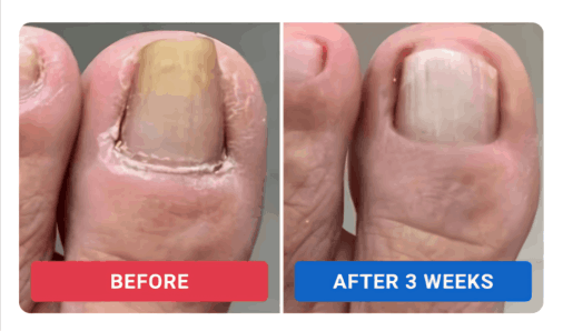 Orivelle Anti-Fungal Pen Customer -Reem K. Ohio, USA